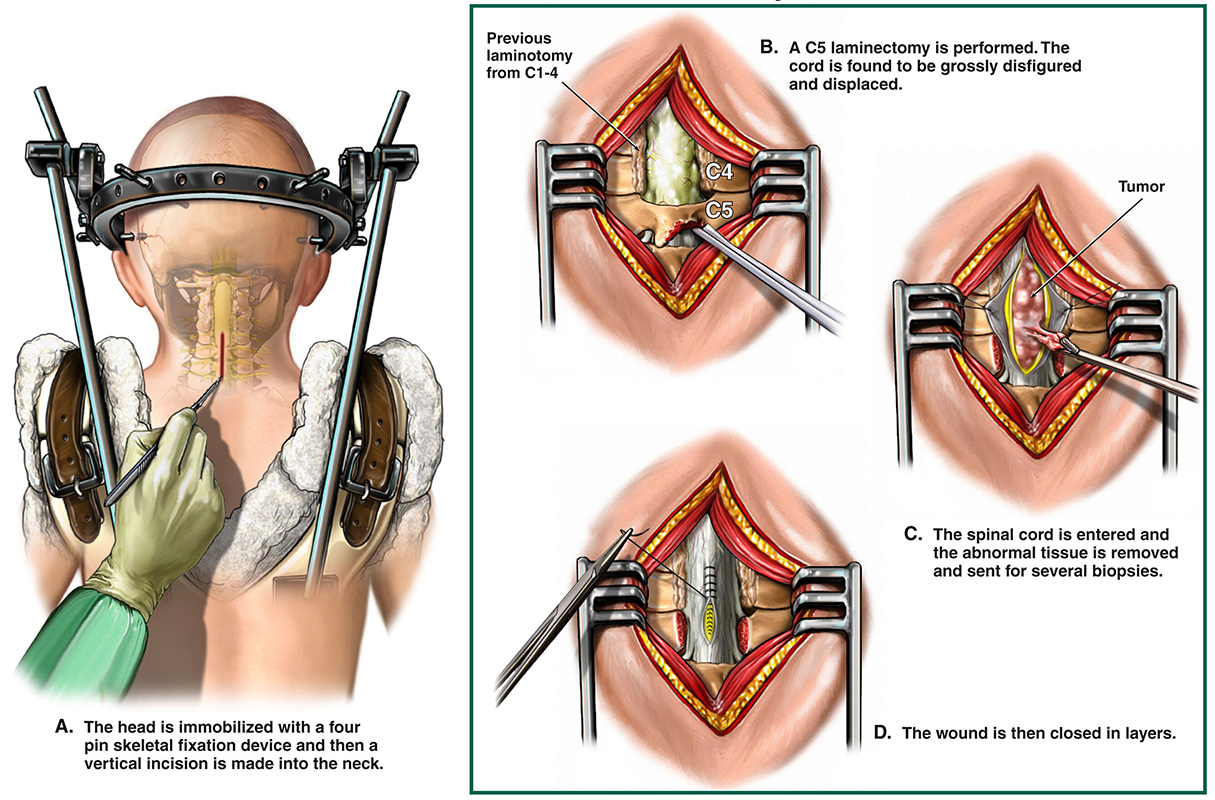 Spinal Tumors Symptoms And Causes City Of Hope California 6152